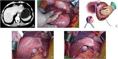 Bisegmentectomy 7–8 for Small-for-Size Remanant Liver for Cirrhotic Patients Under Right Hemi-hepatectomy With Hepatocellular Carcinoma: A Case-Matched Comparative Study